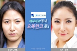 매부리코성형