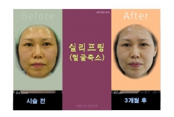 실리프팅(얼굴축소)