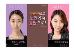 지방이식으로 동안됐어요..